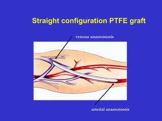 Straight configuration PTFE graft
venous anastomosis
arterial anastomosis
 