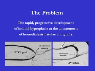 The Problem
The rapid, progressive development
of intimal hyperplasia at the anastomosis
of hemodialysis fistulae and grafts.
anastomotic
stenosis
PTFE graft anastomotic
stenosis
AV fistula
 