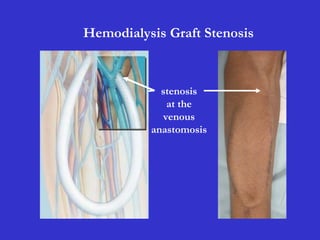Hemodialysis Graft Stenosis
stenosis
at the
venous
anastomosis
 