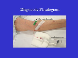Diagnostic Fistulogram
21 g butterfly needle
non-ionic contrast
 