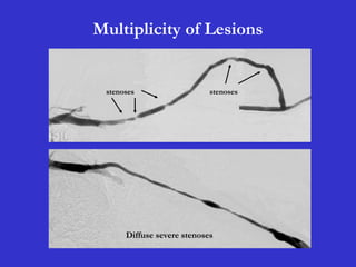 Diffuse severe stenoses
stenoses stenoses
Multiplicity of Lesions
 
