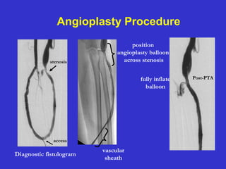 Angioplasty Procedure
Diagnostic fistulogram
access
vascular
sheath
position
angioplasty balloon
across stenosis
fully inflate
balloon
stenosis
Post-PTA
 