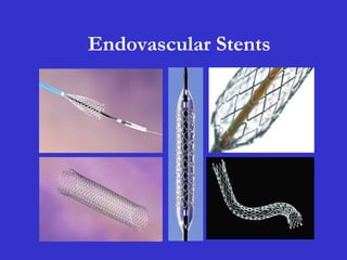 Endovascular Stents
 