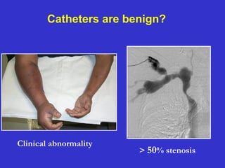 Clinical abnormality
> 50% stenosis
Catheters are benign?
 