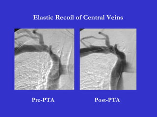 Post-PTA
Elastic Recoil of Central Veins
Pre-PTA
 