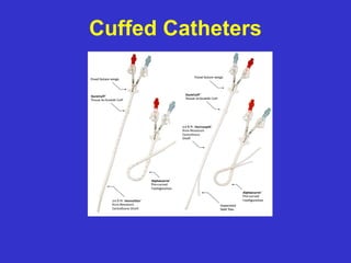 Cuffed Catheters
 