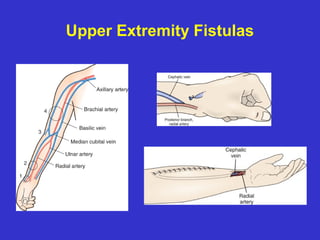 Upper Extremity Fistulas
 