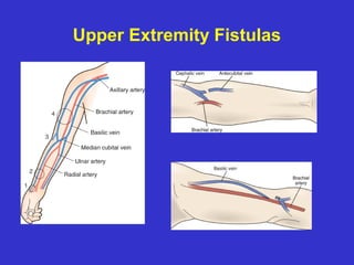 Upper Extremity Fistulas
 