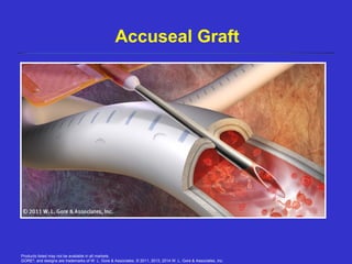 Products listed may not be available in all markets.
GORE®
, and designs are trademarks of W. L. Gore & Associates. © 2011, 2013, 2014 W. L. Gore & Associates, Inc.
Accuseal Graft
 