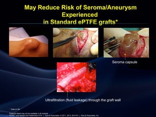 May Reduce Risk of Seroma/Aneurysm
Experienced
in Standard ePTFE grafts*
Seroma capsule
Ultrafiltration (fluid leakage) through the graft wall
Products listed may not be available in all markets.
GORE®
, and designs are trademarks of W. L. Gore & Associates. © 2011, 2013, 2014 W. L. Gore & Associates, Inc.
* Data on file
 