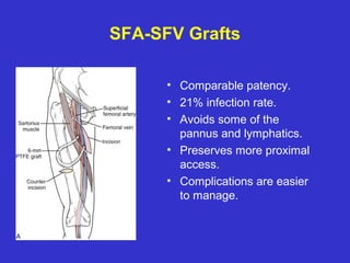 SFA-SFV Grafts
• Comparable patency.
• 21% infection rate.
• Avoids some of the
pannus and lymphatics.
• Preserves more proximal
access.
• Complications are easier
to manage.
 