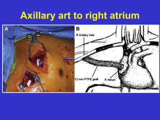 Axillary art to right atrium
 