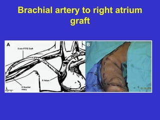 Brachial artery to right atrium
graft
 