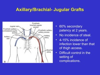 Axillary/Brachial- Jugular Grafts
• 60% secondary
patency at 2 years.
• No incidence of steal.
• 4-15% incidence of
infection lower than that
of thigh access.
• Difficult control in the
setting of
complications.
 