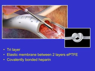 • Tri layer
• Elastic membrane between 2 layers ePTFE
• Covalently bonded heparin
 
