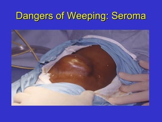 Dangers of Weeping: SeromaDangers of Weeping: Seroma
 