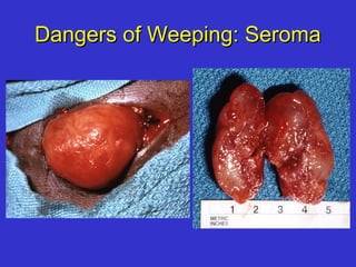 Dangers of Weeping: SeromaDangers of Weeping: Seroma
 