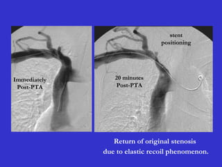 Immediately
Post-PTA
20 minutes
Post-PTA
stent
positioning
Return of original stenosis
due to elastic recoil phenomenon.
 