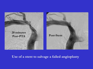 20 minutes
Post-PTA Post-Stent
Use of a stent to salvage a failed angioplasty
 