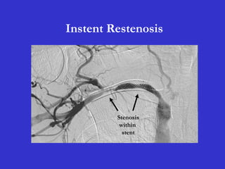 Instent Restenosis
Stenosis
within
stent
 