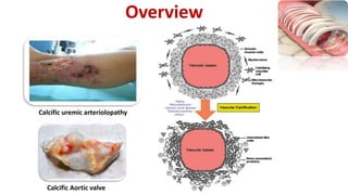 Calcific uremic arteriolopathy
Calcific Aortic valve
Overview
 