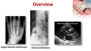 Aortic CalcificationsDigital Arteries Calcification
Overview
 