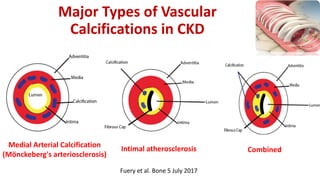 Major Types of Vascular
Calcifications in CKD
Medial Arterial Calcification
(Mönckeberg's arteriosclerosis)
Intimal atherosclerosis Combined
Fuery et al. Bone 5 July 2017
 