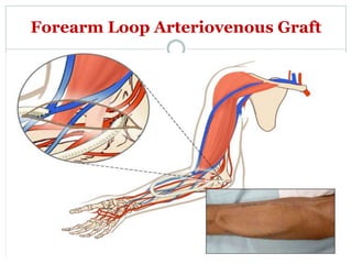 Forearm Loop Arteriovenous Graft
 