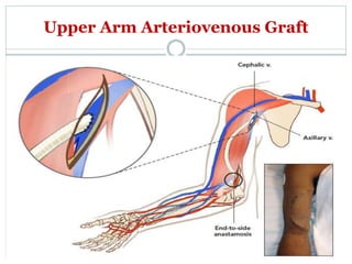 Upper Arm Arteriovenous Graft
 