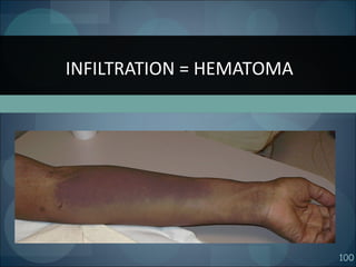 100
INFILTRATION = HEMATOMA
 