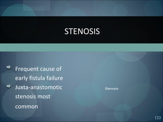 110
Frequent cause of
early fistula failure
Juxta-anastomotic
stenosis most
common
STENOSIS
Stenosis
 