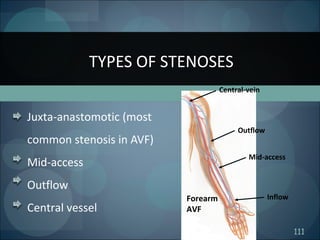 111
Juxta-anastomotic (most
common stenosis in AVF)
Mid-access
Outflow
Central vessel
TYPES OF STENOSES
Outflow
Central-vein
Mid-access
InflowForearm
AVF
 
