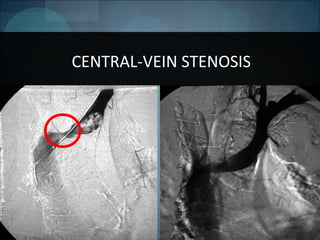 112
CENTRAL-VEIN STENOSIS
 