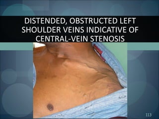 113
DISTENDED, OBSTRUCTED LEFT
SHOULDER VEINS INDICATIVE OF
CENTRAL-VEIN STENOSIS
 