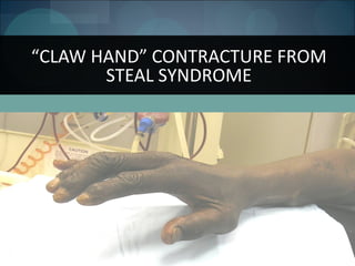 122
“CLAW HAND” CONTRACTURE FROM
STEAL SYNDROME
 