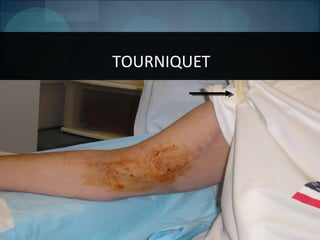 16
TOURNIQUET
 