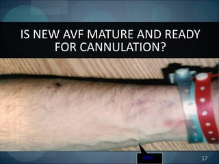 17
IS NEW AVF MATURE AND READY
FOR CANNULATION?
AVF
 