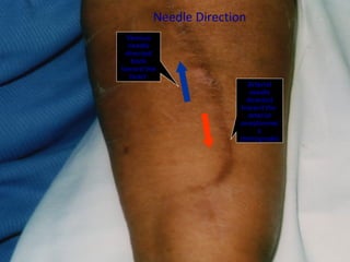35
Venous
needle
directed
back
toward the
heart
Arterial
needle
directed
toward the
arterial
anastomosi
s
(retrograde)
Needle Direction
 