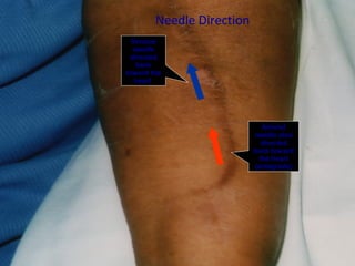 36
Venous
needle
directed
back
toward the
heart
Arterial
needle also
directed
back toward
the heart
(antegrade)
Needle Direction
 