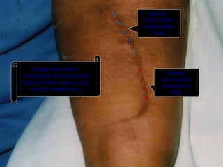 63
Proper site-rotation
cannulation technique with
rotation of both venous and
arterial needle sites
Venous
site-rotation
cannulation
sites
Arterial
site-rotation
cannulation
sites
 