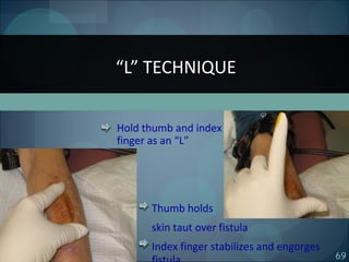 69
“L” TECHNIQUE
Hold thumb and index
finger as an “L”
Thumb holds
skin taut over fistula
Index finger stabilizes and engorges
 