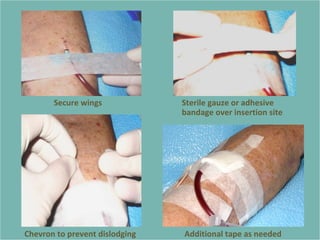 71
Secure wings Sterile gauze or adhesive
bandage over insertion site
Chevron to prevent dislodging Additional tape as needed
 