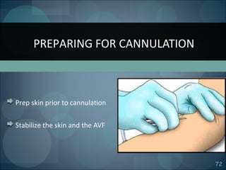 72
Prep skin prior to cannulation
Stabilize the skin and the AVF
PREPARING FOR CANNULATION
 
