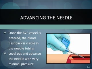 74
Once the AVF vessel is
entered, the blood
flashback is visible in
the needle tubing
Level out and advance
the needle with very
minimal pressure
ADVANCING THE NEEDLE
 