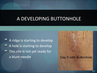 87
A ridge is starting to develop
A hole is starting to develop
This site is not yet ready for
a blunt needle
A DEVELOPING BUTTONHOLE
 