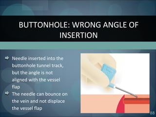88
Needle inserted into the
buttonhole tunnel track,
but the angle is not
aligned with the vessel
flap
The needle can bounce on
the vein and not displace
the vessel flap
BUTTONHOLE: WRONG ANGLE OF
INSERTION
 