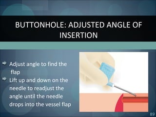 89
Adjust angle to find the
flap
Lift up and down on the
needle to readjust the
angle until the needle
drops into the vessel flap
BUTTONHOLE: ADJUSTED ANGLE OF
INSERTION
 