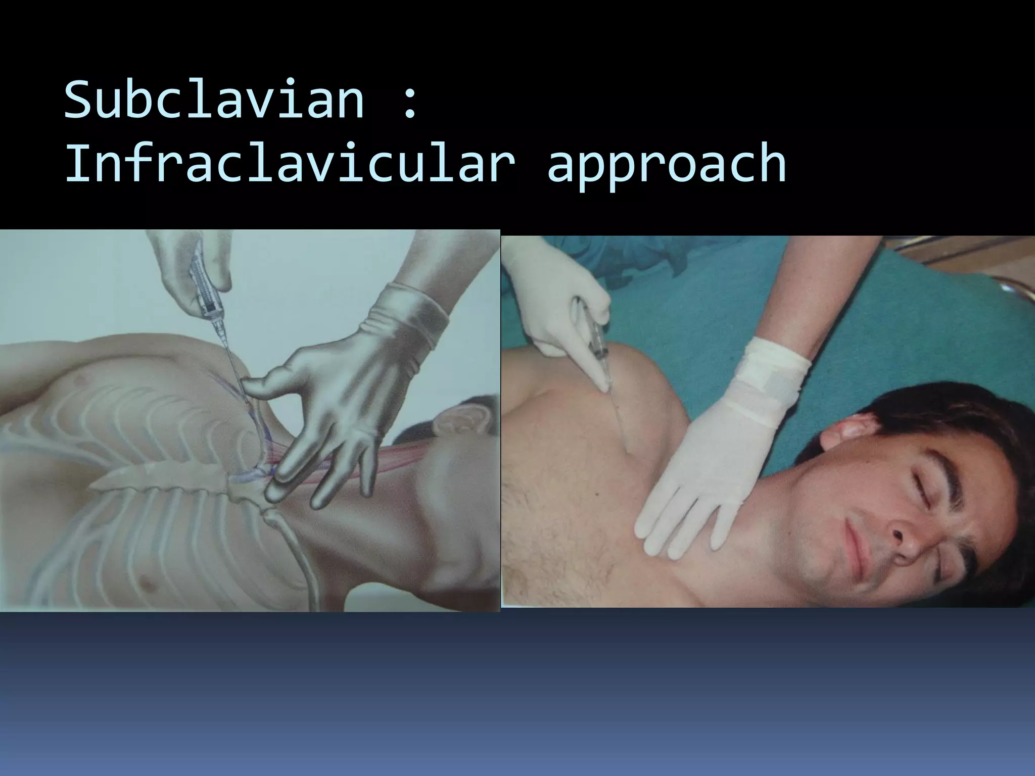 Subclavian :
Infraclavicular approach
 