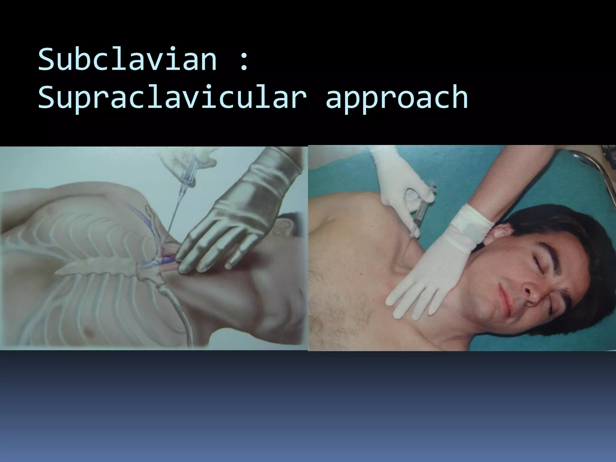 Subclavian :
Supraclavicular approach
 