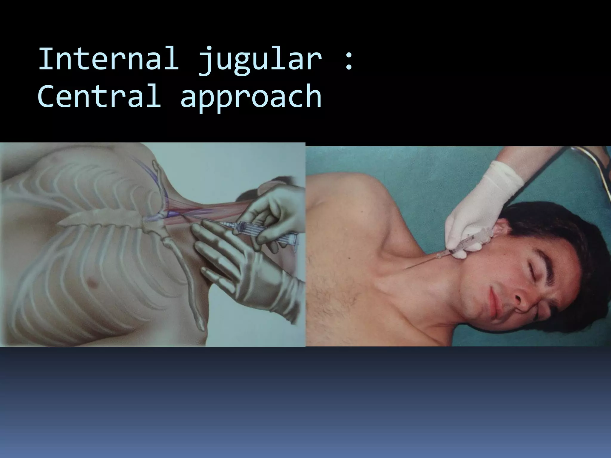 Internal jugular :
Central approach
 